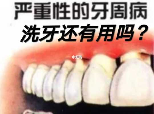 做完牙周護(hù)理能吃生姜嗎（牙周治療后可以吃火鍋嗎）-圖3