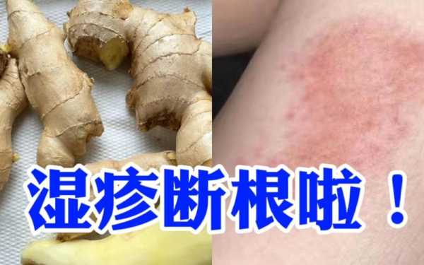 濕疹可以用生姜包腳嗎（濕疹用生姜來涂會好嗎）