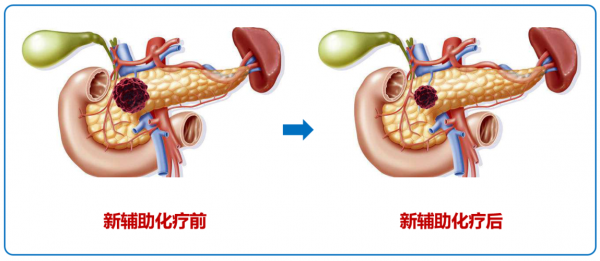 胰腺癌化療后能吃生姜嗎（胰腺癌化療能喝牛奶嗎）-圖3