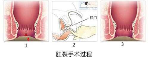 肛裂喝生姜水（肛裂能不能吃姜）-圖3