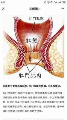 肛裂喝生姜水（肛裂能不能吃姜）-圖2