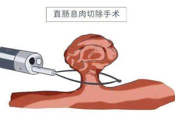 腸息肉患者能吃腌生姜嗎